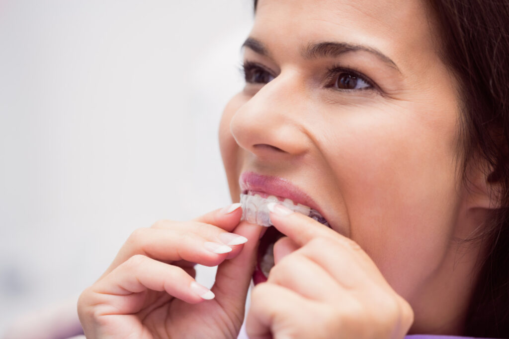 Post-Orthodontic Retainers